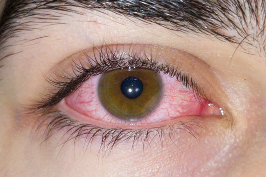 Illustration du guide Joly Beauty : Les faux cils peuvent-ils provoquer une infection de l’œil 