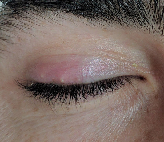 Illustration du guide Joly Beauty : Peut-on porter des faux cils quand on a un orgelet 